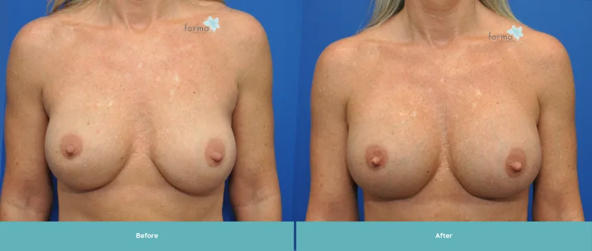 Woman's torso before and after breast implant exchange procedure