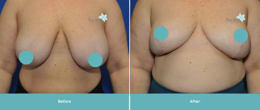 Breast Reduction before and after