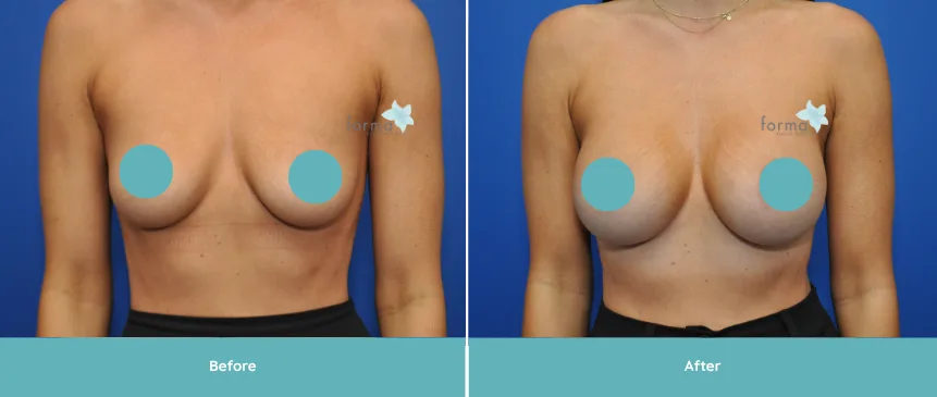 Breast Augmentation before and after