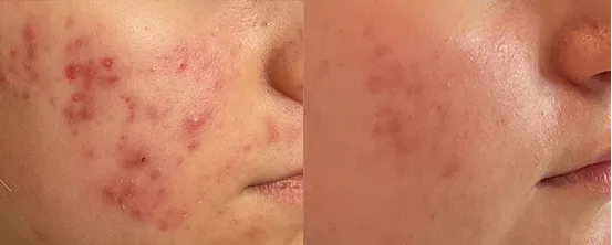 Before and after close-up of cheek showing acne lesions reduced and skin texture improved