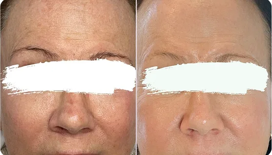 Before and after frontal view of forehead showing reduced fine lines and wrinkles