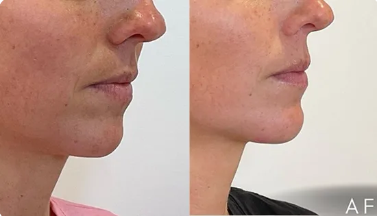 Before and after side profile showing enhanced cheekbone and jawline definition