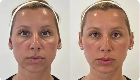 Before and after facial balancing with dermal filler showing improved cheek and under-eye contours