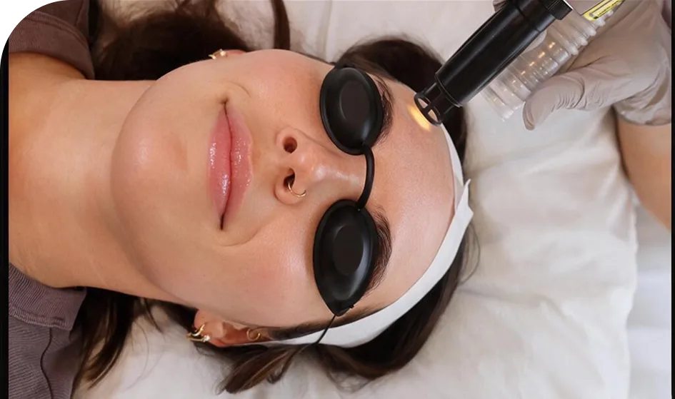 Patient wearing protective eyewear receives GlowPeel laser treatment on face