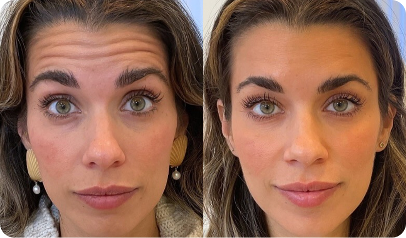 Before and after facial comparison showing reduced forehead lines from neurotoxin treatment