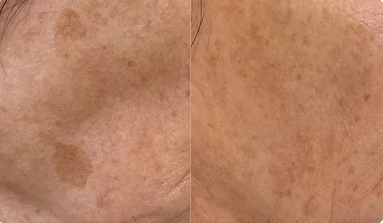 Before and after comparison of neck and décolletage showing reduced brown spots and sun damage