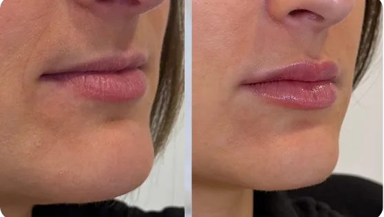 Before and after lip filler treatment showing fuller lips with enhanced volume and definition