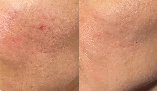 Before and after close-up of textured skin showing reduced scarring and smoother surface