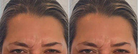 Before and after forehead showing reduced wrinkles between eyebrows