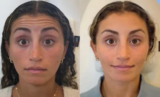 Before and after facial comparison showing reduced forehead lines and smoother brow area