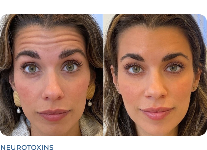 Before and after facial comparison showing reduced forehead lines from neurotoxin treatment