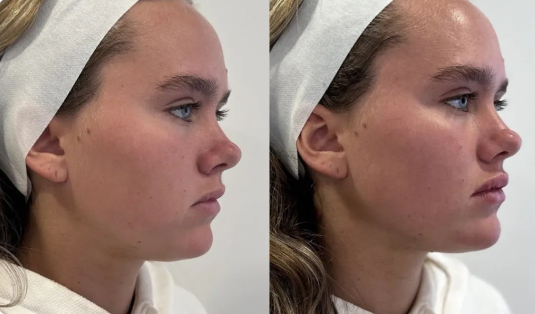 Side-by-side before and after profile images of woman showing facial contouring results