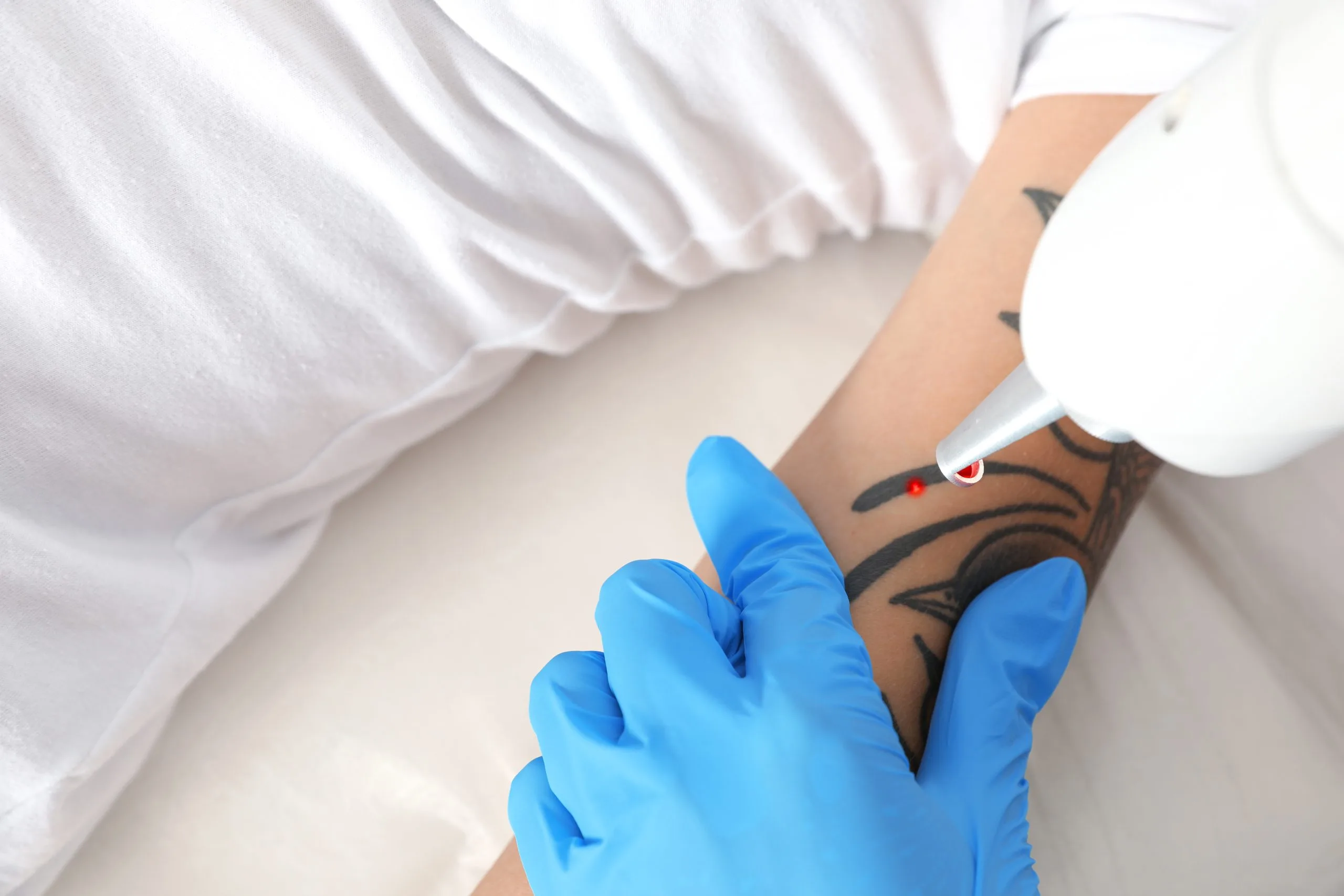 Laser tattoo removal procedure being performed on patient's tattooed arm in salon