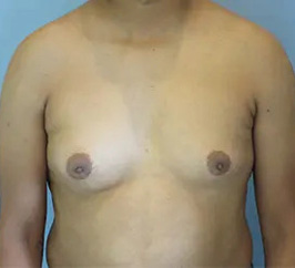Case 10A before