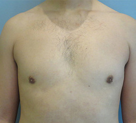 Case 8A after