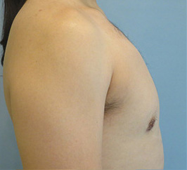 Case 8b after