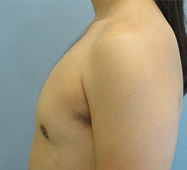 Case 8d after