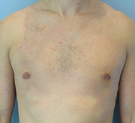 Case 1A After