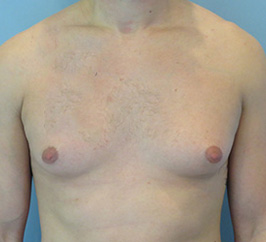 Case 1A before