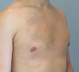 Case 1B after