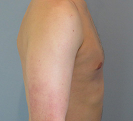 Case 1C after