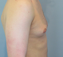 Case 1C before