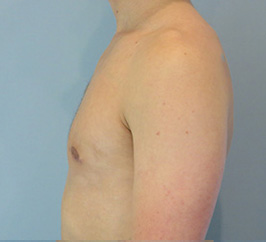 Case 1E after