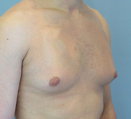 Case 1b before