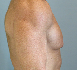 Gynecomastia Surgery Before and After Case 10