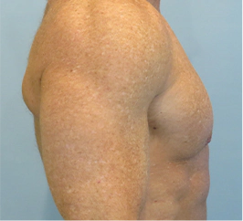 Gynecomastia Surgery Before and After Case 10