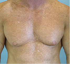 Gynecomastia Surgery Before and After Case 10