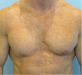 Gynecomastia Surgery Before and After Case 10