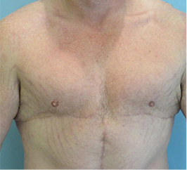 Gynecomastia Surgery Before and After Case 2