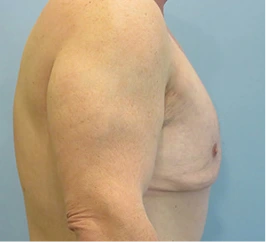 Gynecomastia Surgery Before and After Case 2