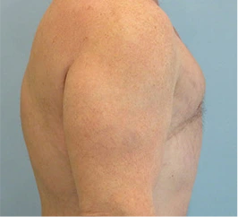 Gynecomastia Surgery Before and After Case 2