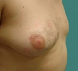 Gynecomastia Surgery Before and After Case 3