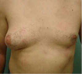 Gynecomastia Surgery Before and After Case 3