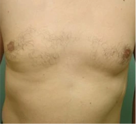 Gynecomastia Surgery Before and After Case 3