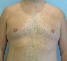 Gynecomastia Surgery Before and After Case 5