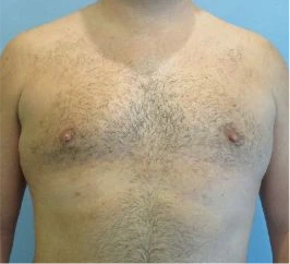 Gynecomastia Surgery Before and After Case 5