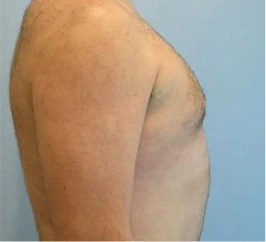 Gynecomastia Surgery Before and After Case 5