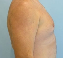 Gynecomastia Surgery Before and After Case 5