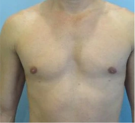 Gynecomastia Surgery Before and After Case 6