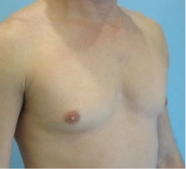 Gynecomastia Surgery Before and After Case 6