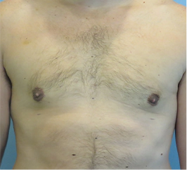 Gynecomastia Surgery Before and After Case 8