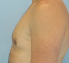 Gynecomastia Surgery Before and After Case 8