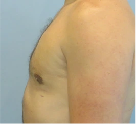 Gynecomastia Surgery Before and After Case 8