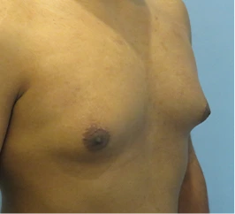 Gynecomastia Surgery Before and After Case 9