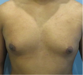 Gynecomastia Surgery Before and After Case 9
