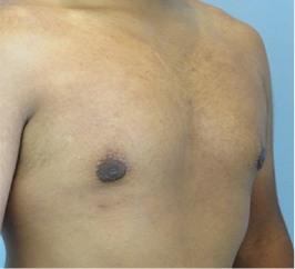 Gynecomastia Surgery Before and After Case 9